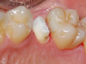 RECONSTITUTION-9-Dent-taillée-prête-pour-lempreinte-300x225