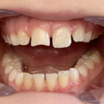 0-PureShade Anterior INITIAL