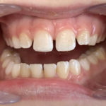 1-PureShade Anterior FINAL