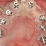 1. Surgical guide with transfer placement