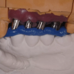 11. RIM Check on Implant Abutments 5