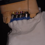 12. RIM Check on Implant Abutments 6