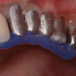 14. RIM check and adaptation of supra-implant framework 2