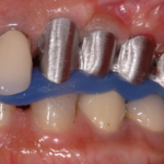 15. RIM check and adaptation of supra-implant framework 3