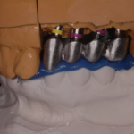 17. RIM check and adaptation of supra-implant framework 5