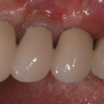 19. Checking the ceramic framework in the mouth