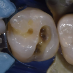 2. Après application d'adhésif Healbond Universal