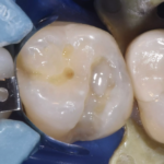 3. Application of PUREFILL Flow in the cavity