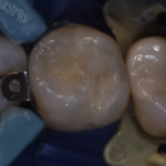 4. Composite PURESHADE set up & sculpture of the occlusal surface