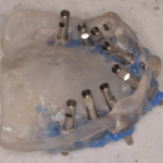 5. Implant analogs in place