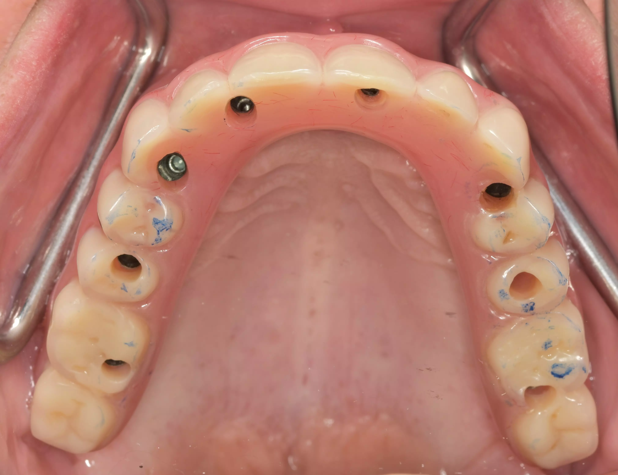 Elsodent - DUROC Clinical Case #2