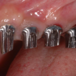 7. RIM Check on Implant Abutments 1
