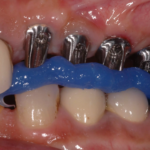 9. RIM Check on Implant Abutments 3