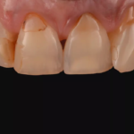 Elsodent - CAS CLINIQUE PURESHADE #1