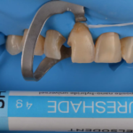 3. Composites déposés, dents préparées, mordancées et adhésif appliqué sur les zones concernées (HEALBOND Universal)