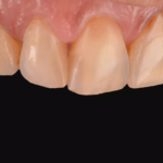 4. Obturations avec le composite PURESHADE réalisées sur les 3 cavités. Polissage terminé